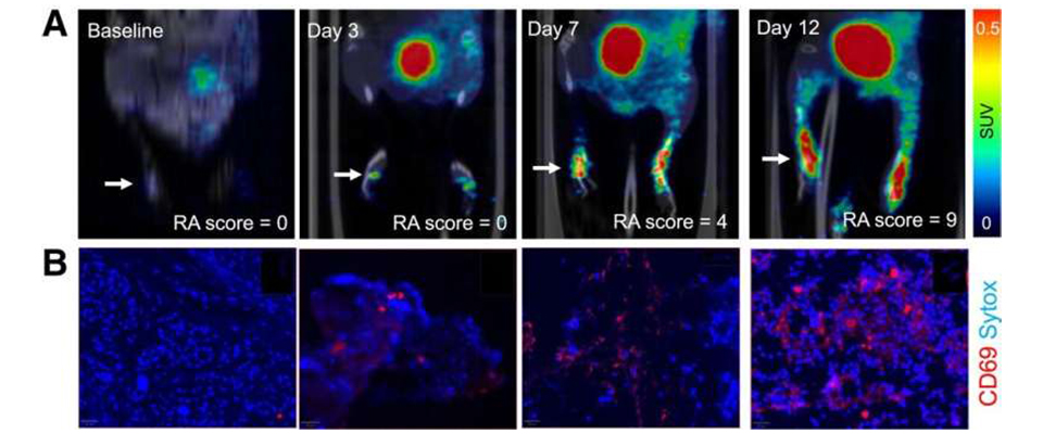 (A) PET images of [68Ga]Ga-DOTA-ZCAM241 uptake at baseline and 3, 7, and 12 days after injection as inflammatory arthritis developed in single representative individual mouse. Images are normalised to SUV of 0.5 for direct comparison between time points. (B) CD69 immunofluorescence Sytox (Thermo Fisher Scientific) staining of joints of representative animals during matching time points. Credit: E. Puuvuori and Y. Shen, et al, Uppsala University, Uppsala, Sweden and Karolinska Institutet, Solna, Sweden