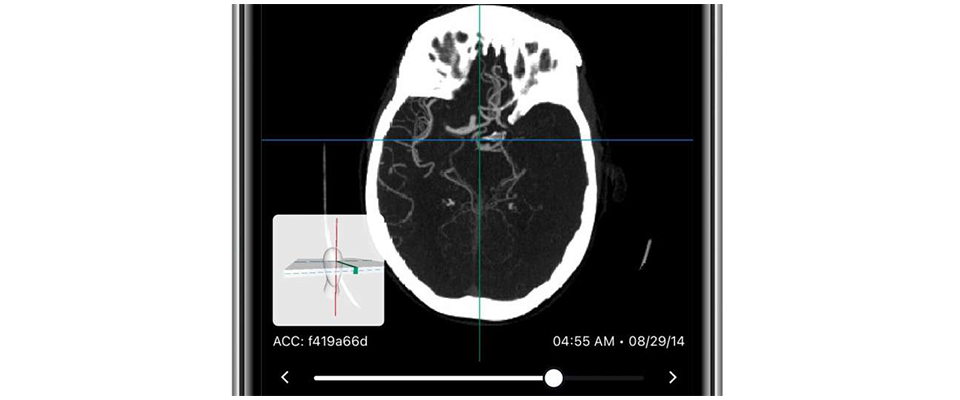 Viz LVO allows clinicians and radiologists to receive real-time alerts to their mobile phones, notifying them of possible LVO within moments of CT imaging completion. Credit: Demo image courtesy of Viz.ai